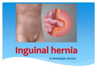 Inguinal hernia
Dr.MOHAMED RUVAIS
 