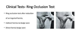 Inguinal Hernia presentation in General surgery | PPTX