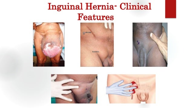 A Inguinal Hernia Indicated With Arrow In An Infertile Adult
