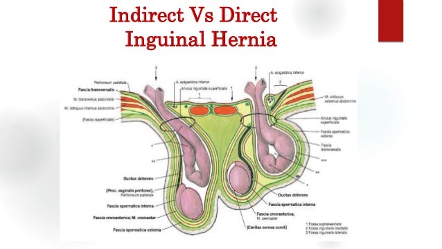 Inguinal Hernia- Groin Swellings Inguinal Hernia- Groin Swellings