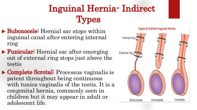 Inguinal Hernia Groin Swellings