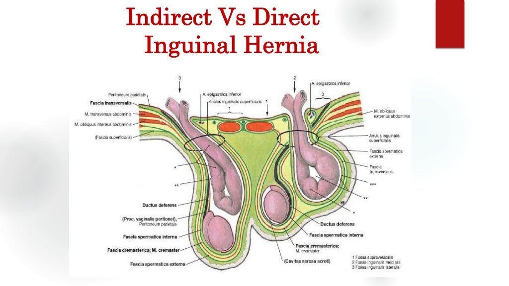 Inguinal Hernia Groin Swellings