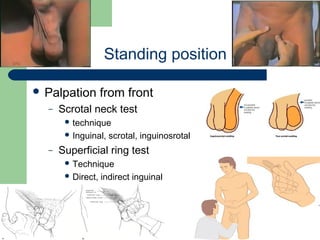 University of
Alexandria
Standing position
 Palpation from front
– Scrotal neck test
 technique
 Inguinal, scrotal, inguinosrotal
– Superficial ring test
 Technique
 Direct, indirect inguinal
 