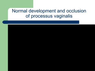 University of
Alexandria
Normal development and occlusion
of processus vaginalis
 