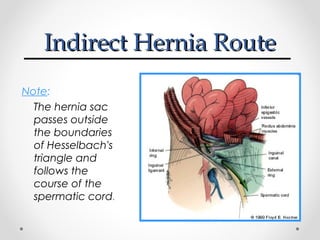 Indirect Hernia Route
Note:
The hernia sac
passes outside
the boundaries
of Hesselbach's
triangle and
follows the
course of the
spermatic cord.

 