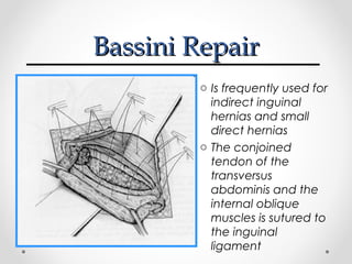 Bassini Repair
o Is frequently used for
indirect inguinal
hernias and small
direct hernias
o The conjoined
tendon of the
transversus
abdominis and the
internal oblique
muscles is sutured to
the inguinal
ligament

 