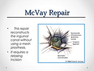 McVay Repair
This repair
reconstructs
the inguinal
canal without
using a mesh
prosthesis.
• It requires a
relaxing
incision
•

 