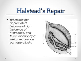 Halstead’s Repair
• Technique not
appreciated
because of high
incidence of
hydrocoels, and
testicular atrophy as
well as recurrence
post-operatively.

 