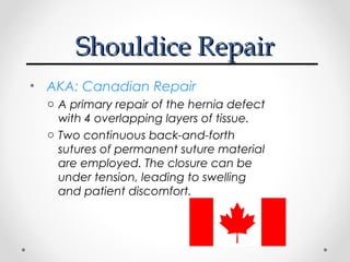 Shouldice Repair
• AKA: Canadian Repair
o A primary repair of the hernia defect
with 4 overlapping layers of tissue.
o Two continuous back-and-forth
sutures of permanent suture material
are employed. The closure can be
under tension, leading to swelling
and patient discomfort.

 