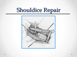 Shouldice Repair

 