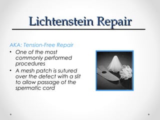 Lichtenstein Repair
AKA: Tension-Free Repair
• One of the most
commonly performed
procedures
• A mesh patch is sutured
over the defect with a slit
to allow passage of the
spermatic cord

 