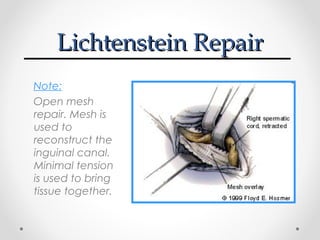 Lichtenstein Repair
Note:
Open mesh
repair. Mesh is
used to
reconstruct the
inguinal canal.
Minimal tension
is used to bring
tissue together.

 