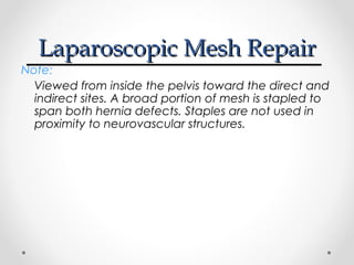 Laparoscopic Mesh Repair

Note:
Viewed from inside the pelvis toward the direct and
indirect sites. A broad portion of mesh is stapled to
span both hernia defects. Staples are not used in
proximity to neurovascular structures.

 