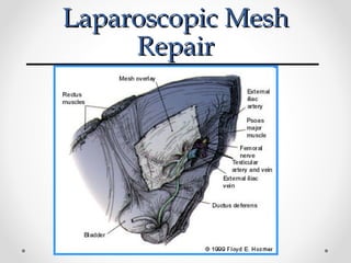 Laparoscopic Mesh
Repair

 