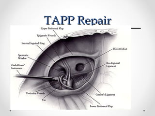 TAPP Repair

 