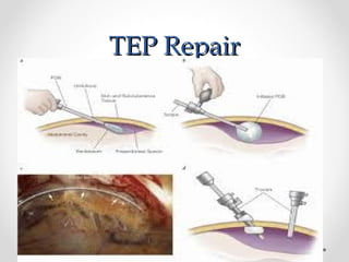 TEP Repair

 