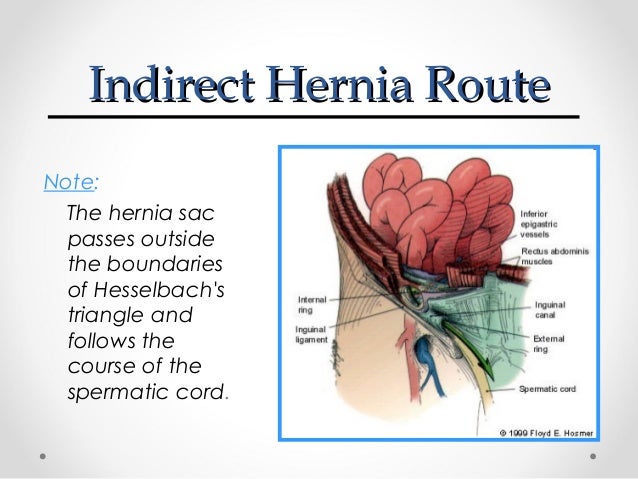 Inguinal Hernia