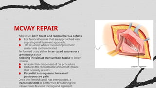 Mcvay Incision Inguinal Hernia powerpoint - surgery review | PPTX