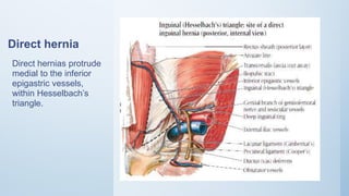 Direct hernia
Direct hernias protrude
medial to the inferior
epigastric vessels,
within Hesselbach’s
triangle.
 