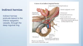 Indirect hernias
Indirect hernias
protrude lateral to the
inferior epigastric
vessels, through the
deep inguinal ring.
 