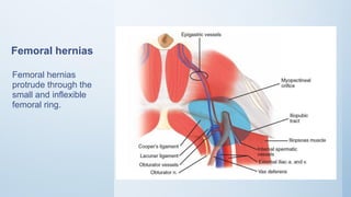Femoral hernias
Femoral hernias
protrude through the
small and inflexible
femoral ring.
 