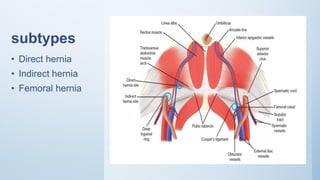 subtypes
• Direct hernia
• Indirect hernia
• Femoral hernia
 