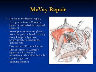 Mcvay Incision Inguinal hernia lecture............. .ppt