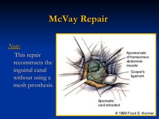 Mcvay Incision Inguinal hernia the lec........... t.ppt
