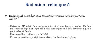 Radiation technique 5
V. Segmental boost [photon thunderbird with skin/Superficial
match]
• Extended AP pelvic field to in...