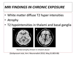 MRI FINDINGS IN CHRONIC EXPOSURE
• White matter diffuse T2 hyper intensities
• Atrophy
• T2 hypointensities in thalami and basal ganglia
Marked atrophy of brain in inhalant abuser
(Geibprasert etal, Am J Neuroradiol 2010, May,31:803-08)
 