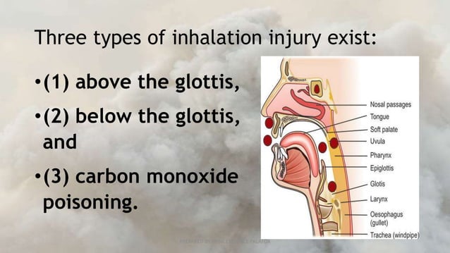 Inhalition Injuries INHALATION-INJURY nursing lesson to prevent complications | PPTX