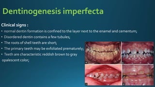 Dentinogenesis imperfecta
Clinical signs :