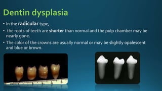 Dentin dysplasia