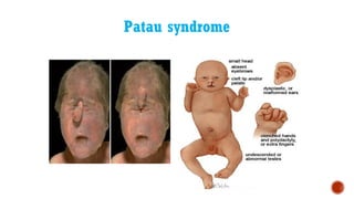 Patau syndrome
 