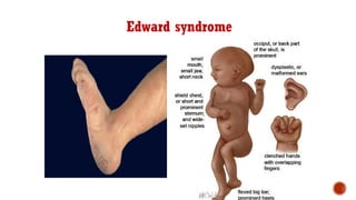 Edward syndrome
 