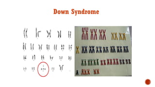 Down Syndrome
 