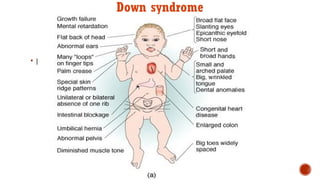  |
Down syndrome
 