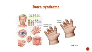 Down syndrome
 