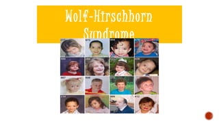 Wolf-Hirschhorn
Syndrome
 