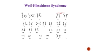 Wolf-Hirschhorn Syndrome
 