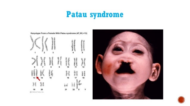 View Missing Chromosome 18 Disorder Pics