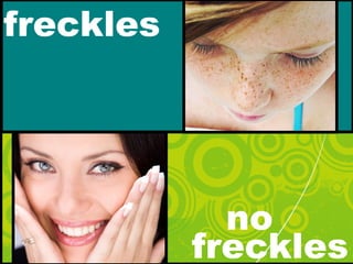 freckles
no
freckles
 