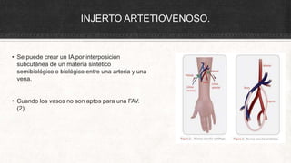 INJERTO ARTETIOVENOSO.
• Se puede crear un IA por interposición
subcutánea de un materia sintético
semibiológico o biológico entre una arteria y una
vena.
• Cuando los vasos no son aptos para una FAV.
(2)
 