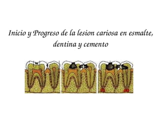 Inicio y Progreso de la lesion cariosa en esmalte, 
               dentina y cemento
 
