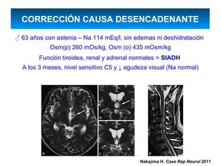 CORRECCIÓN CAUSA DESENCADENANTE

♂ 63 años con astenia – Na 114 mEq/l, sin edemas ni deshidratación
            Osm(p) 260 mOs/kg, Osm (o) 435 mOsm/kg
        Función tiroidea, renal y adrenal normales = SIADH
  A los 3 meses, nivel sensitivo C5 y ↓ agudeza visual (Na normal)




                                            Nakajima H. Case Rep Neurol 2011
 