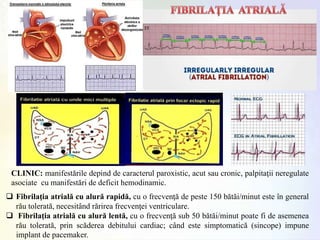 CLINIC: manifestările depind de caracterul paroxistic, acut sau cronic, palpitaţii neregulate
asociate cu manifestări de deficit hemodinamic.
 Fibrilaţia atrială cu alură rapidă, cu o frecvenţă de peste 150 bătăi/minut este în general
rău tolerată, necesitând rărirea frecvenţei ventriculare.
 Fibrilaţia atrială cu alură lentă, cu o frecvenţă sub 50 bătăi/minut poate fi de asemenea
rău tolerată, prin scăderea debitului cardiac; când este simptomatică (sincope) impune
implant de pacemaker.
 