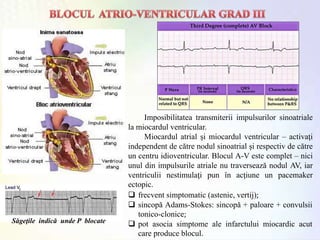 Săgeţile indică unde P blocate
Imposibilitatea transmiterii impulsurilor sinoatriale
la miocardul ventricular.
Miocardul atrial şi miocardul ventricular – activaţi
independent de către nodul sinoatrial şi respectiv de către
un centru idioventricular. Blocul A-V este complet – nici
unul din impulsurile atriale nu traversează nodul AV, iar
ventriculii nestimulaţi pun în acţiune un pacemaker
ectopic.
 frecvent simptomatic (astenie, vertij);
 sincopă Adams-Stokes: sincopă + paloare + convulsii
tonico-clonice;
 pot asocia simptome ale infarctului miocardic acut
care produce blocul.
 