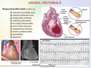  infarctul miocardic acut;
 edemul pulmonar acut;
 tamponada cardiacă;
 embolia pulmonară;
 nevralgia intercostală;
 zona zoster toracică;
 traumatisme toracice;
 artrita condrocostală;
 pericardite;
 pleurezie.
Diagnosticul diferenţial se face cu:
 