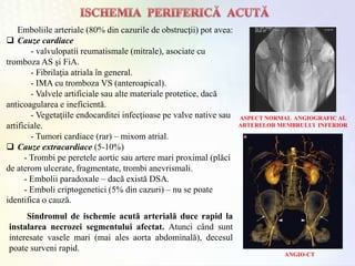 ASPECT NORMAL ANGIOGRAFIC AL
ARTERELOR MEMBRULUI INFERIOR
ANGIO-CT
Sindromul de ischemie acută arterială duce rapid la
instalarea necrozei segmentului afectat. Atunci când sunt
interesate vasele mari (mai ales aorta abdominală), decesul
poate surveni rapid.
Emboliile arteriale (80% din cazurile de obstrucţii) pot avea:
 Cauze cardiace
- valvulopatii reumatismale (mitrale), asociate cu
tromboza AS şi FiA.
- Fibrilaţia atriala în general.
- IMA cu tromboza VS (anteroapical).
- Valvele artificiale sau alte materiale protetice, dacă
anticoagularea e ineficientă.
- Vegetaţiile endocarditei infecţioase pe valve native sau
artificiale.
- Tumori cardiace (rar) – mixom atrial.
 Cauze extracardiace (5-10%)
- Trombi pe peretele aortic sau artere mari proximal (plăci
de aterom ulcerate, fragmentate, trombi anevrismali.
- Embolii paradoxale – dacă există DSA.
- Emboli criptogenetici (5% din cazuri) – nu se poate
identifica o cauză.
 