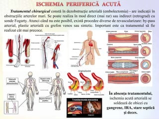 Tratamentul chirurgical constă în dezobstrucţie arterială (embolectomia) - are indicaţii în
obstrucţiile arterelor mari. Se poate realiza în mod direct (mai rar) sau indirect (retrograd) cu
sonde Fogarty. Atunci când nu este posibil, există procedee diverse de revascularizare: by-pass
arterial, plastie arterială cu grefon venos sau sintetic. Important este ca tratamentul să fie
realizat cât mai precoce.
În absenţa tratamentului,
ischemia acută arterială se
soldează de obicei cu
gangrene, IRA, stare septică
şi deces.
 